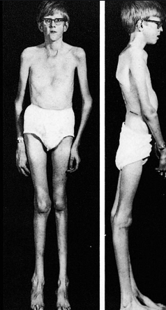 Hombre delgado con Marfan, uno de los síndromes genéticos raros