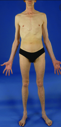 Hombre delgado con slip negro que padece síndrome de Marfan